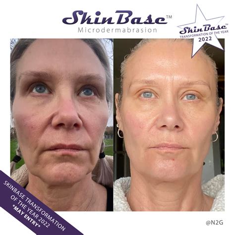 Why Do We Recommend a Microdermabrasion Treatment Course?