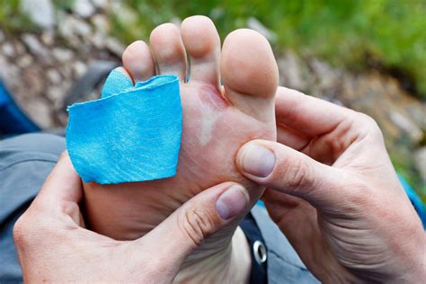 sunburn blisters popped