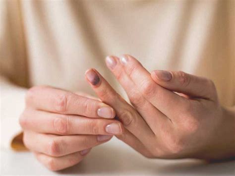 Smashed Finger: Treatment, Recovery, Seeking Help, and More