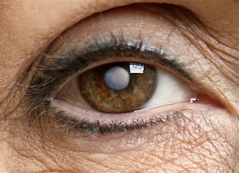 Cataract - Simply Explained - Healthy Bright Eyes