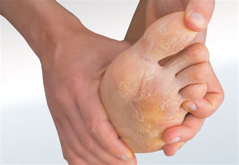 Fungal Infection - Relieve Foot Pain & Leg Pain