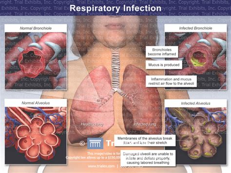 Respiratory Infection - TrialQuest Inc.