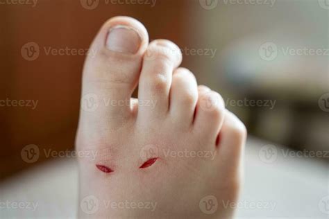 healing of bleeding wounds on a child's leg from cuts 23552615 Stock ...