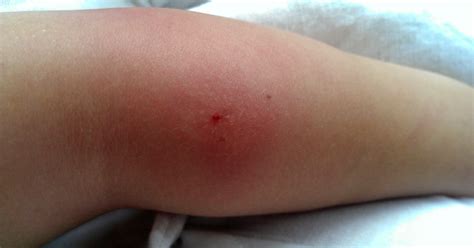 difference   bug bite   staph infection