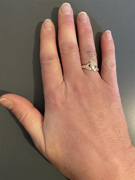 Raynaud’s itching & swelling? : r/Autoimmune