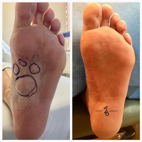 Soft Tissue Mass Removal: Plantar Fibroma - 26 Foot & Ankle