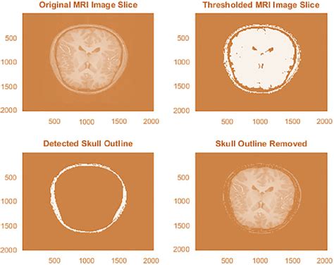 Skull outline detection in brain MRI images | Download Scientific Diagram