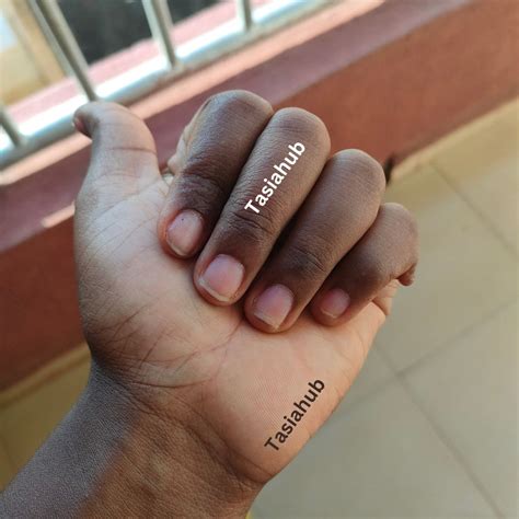 Understanding Onycholysis Of The Nail: Causes, Symptoms And Treatment ...