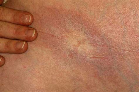 Morphea (Scleroderma): Treatment, Causes, and More