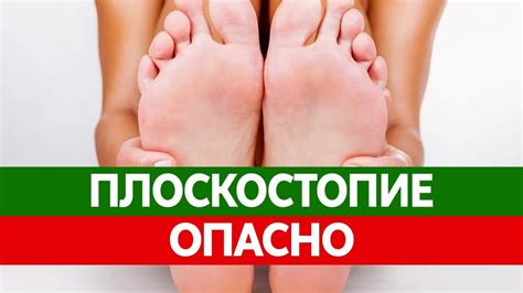 ПЛОСКОСТОПИЕ у взрослых и детей. Чем оно опасно? Можно ли вылечить ...