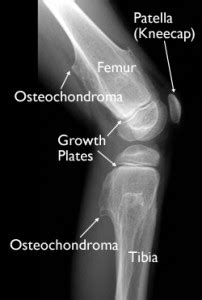 Osteochondroma - Types, Causes, Symptoms, Diagnosis and Treatment