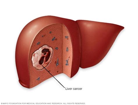 Hepatocarcinoma O Que É - Hepatocarcinoma - Descripción general - Mayo Clinic