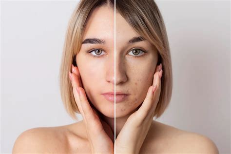 Acne Treatment in Queens | Adult and Pediatric Dermatology