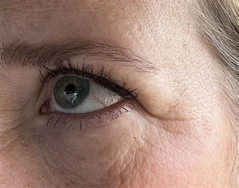 Droopy eyes : r/PlasticSurgery