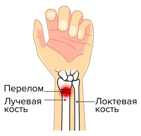 Восстановление руки после перелома лучевой кости со смещением: сколько ...