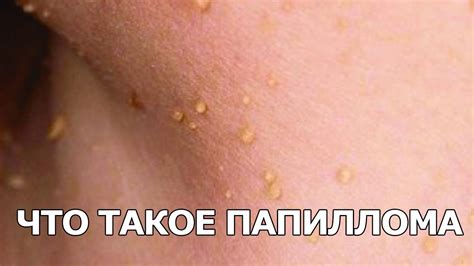 Папиллома — что это? - YouTube