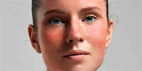 The 4 Stages of Rosacea and Its Treatment - TheOmniBuzz