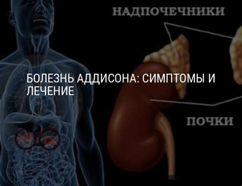Болезнь Аддисона: что это такое, симптомы и лечение, первые признаки