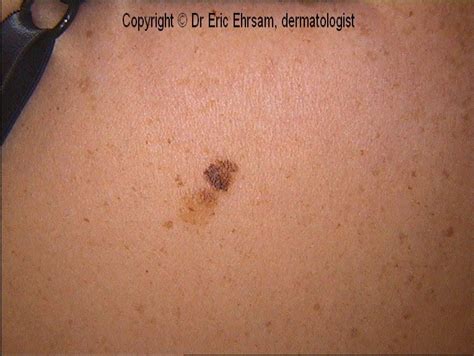 dermoscopy compound melanocytic nevus