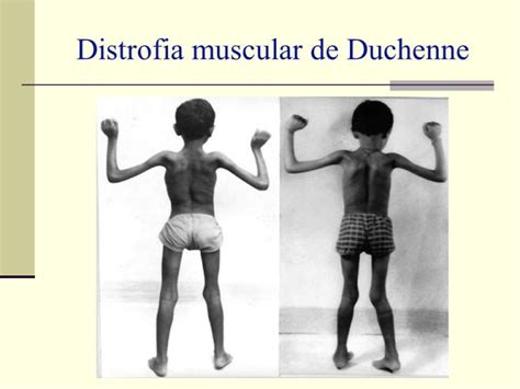 O Que É Distrofia Muscular De Duchenne - O que é Distrofia Muscular de Duchenne, Tratamento, Tem Cura?