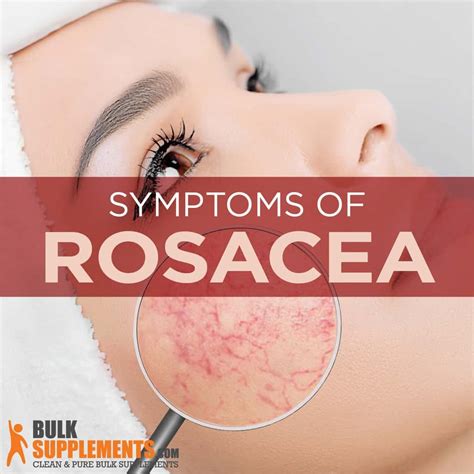 Rosacea: Symptoms, Causes & Treatment