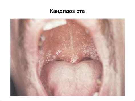 ВИЧ-инфекция - online presentation