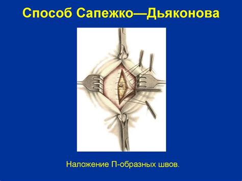 Грыжи живота - презентация онлайн