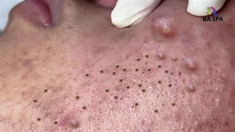 Blackheads Being Popped 2024 - Robbi Christen