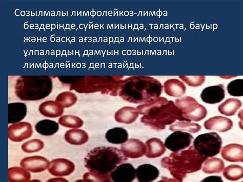 Лимфолейкоз - презентация онлайн