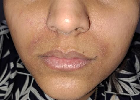 Skin issue/allergic reaction? : r/SkincareAddicts