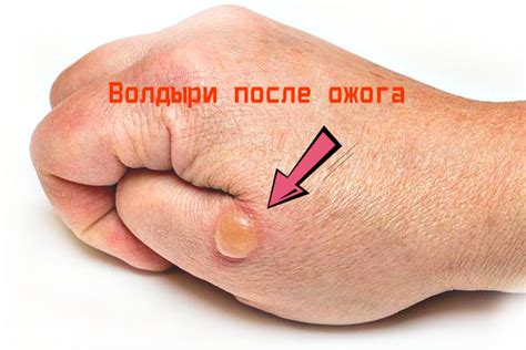 Волдыри после ожогов | Сайт о здоровье