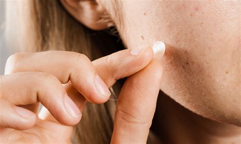 The Common Pimple-Patch Mistake You're Probably Making