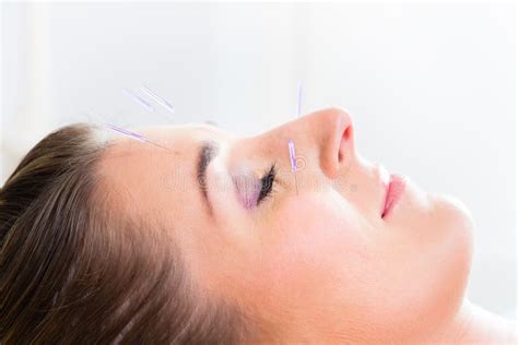 Woman at Acupuncture with Needles in Face Stock Image - Image of health ...