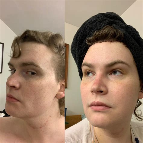 Side by side ffs 6 days post op | Scrolller