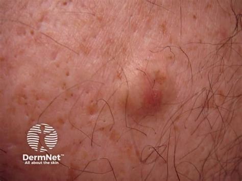 cyst images