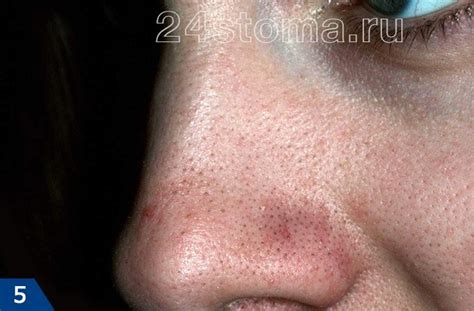 Скинорен гель и крем от прыщей – отзывы дерматолога, инструкция