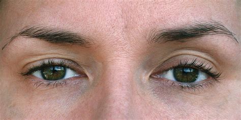 Ptosis | AOA