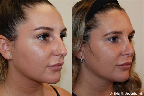 Eric M. Joseph, MD | Rhinoplasty Before & After: Profile Bump and