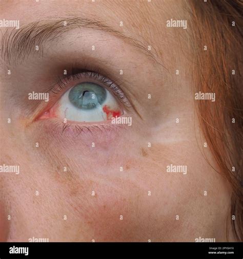 Subconjunctival hemorrhage or subconjunctival bleeding, hyposhagmus ...