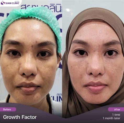 growth factor review siam clinic aesthetic wellness clinic  phuket