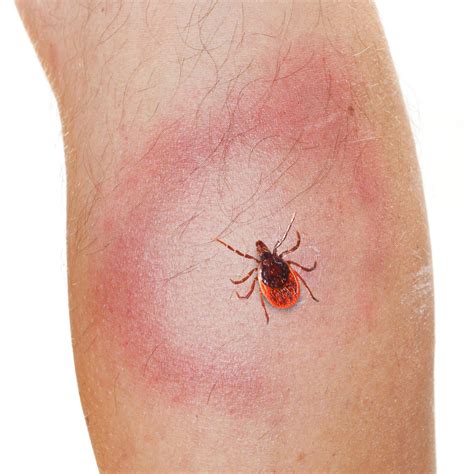 La Maladie De Lyme Sympta Mes Diagnostic Solution 4
