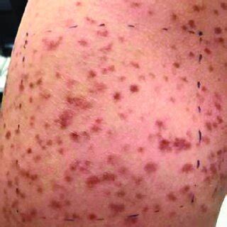 Typical red brown macules in a patient with cutaneous mastocytosis ...