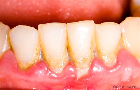 Seven Reasons Your Gums Are Enlarged – Oral Answers