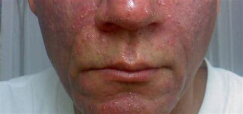 how to get rid of red spots on face quickly