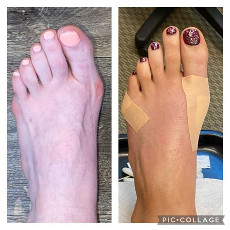 5 weeks post op bilateral bunionectomy, cleared to walk in athletic