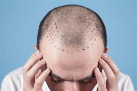Bad Hair Transplants: From Infections to Scars – Revela
