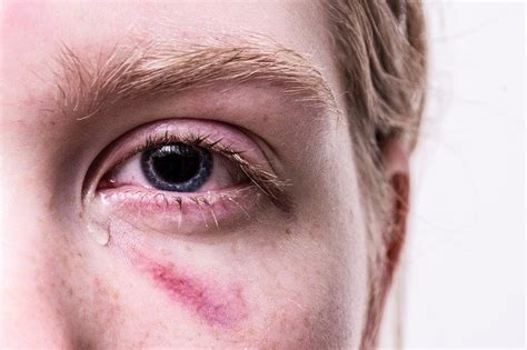 Why do my tears burn my face? The unseen problems and their solutions