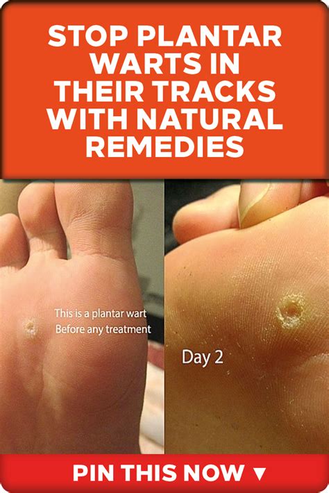 how to get rid of a planters wart at home