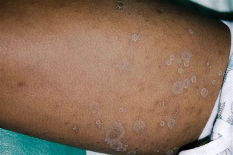 Pityriasis Rosea vs. Ringworm: Symptoms, Types, Treatment