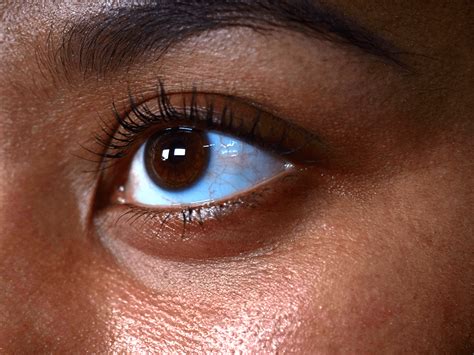 What Color Should The Inside Of My Bottom Eyelid Be Tightening